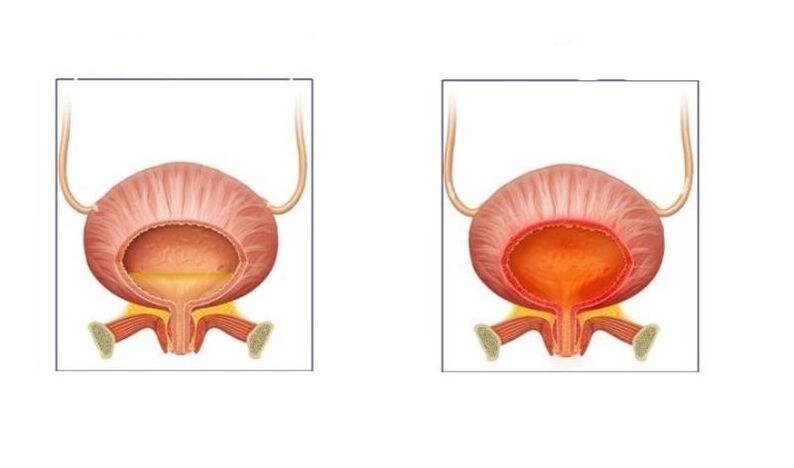 Normaalsed ja uriinitrakti tsüstiidiga patsiendid