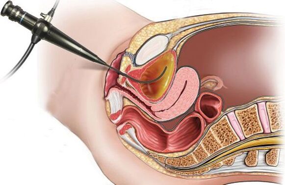 tsüstoskoopia tsüstiidi jaoks